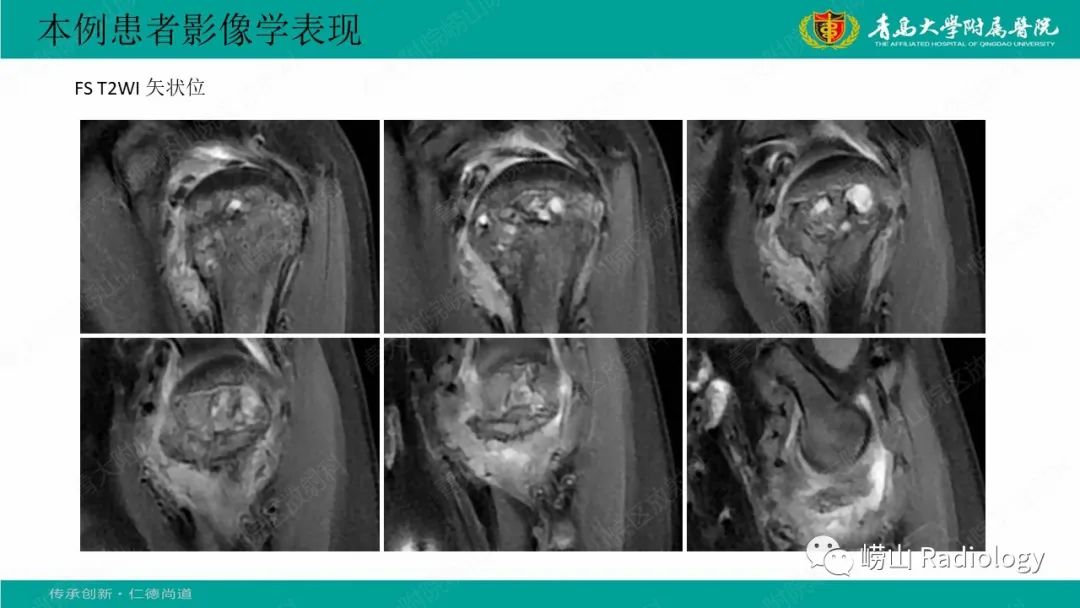 【病例】肱骨干骺端软骨母细胞瘤1例CT及MR-10