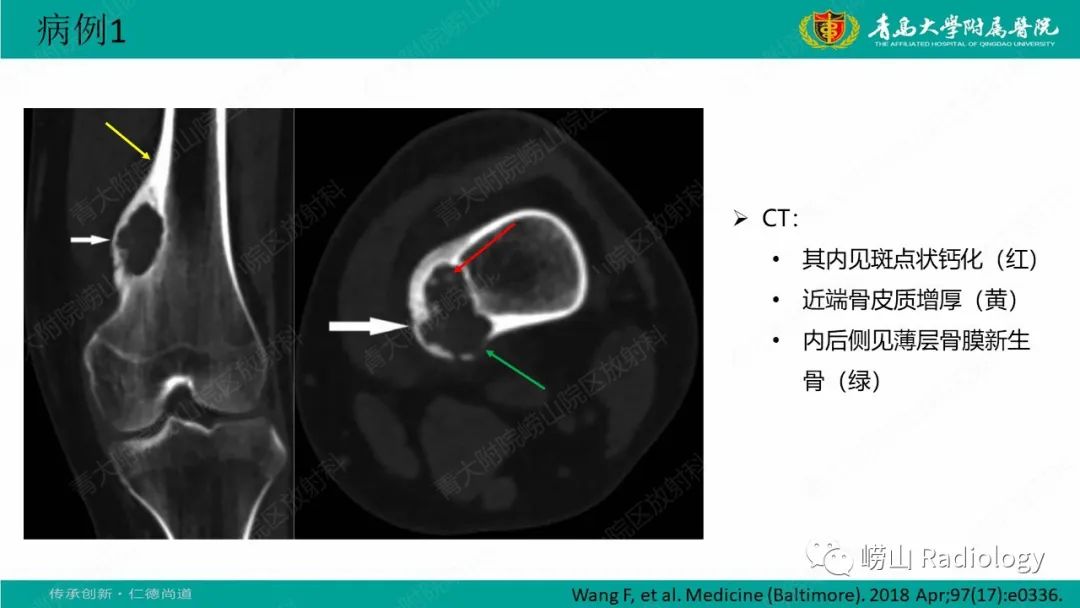 【病例】肱骨干骺端软骨母细胞瘤1例CT及MR-21