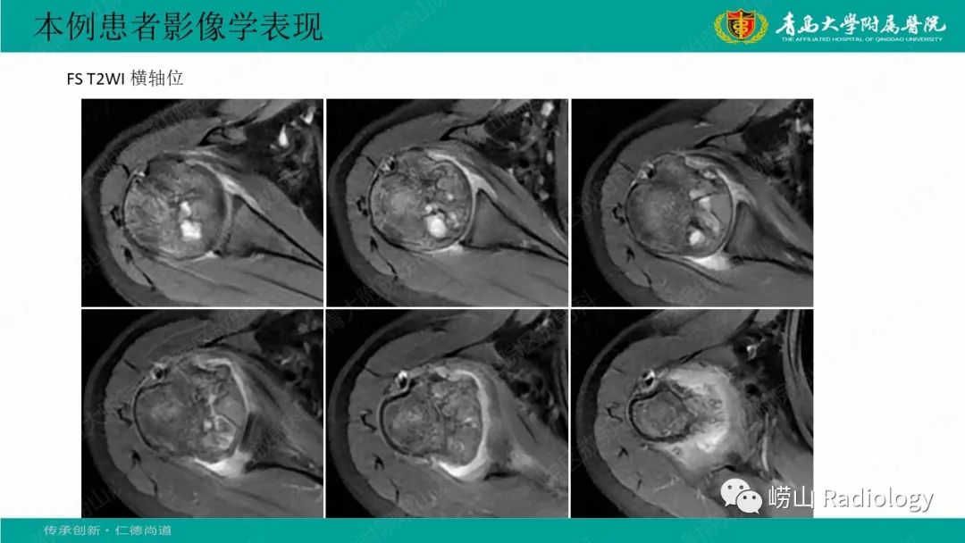 【病例】肱骨干骺端软骨母细胞瘤1例CT及MR-9