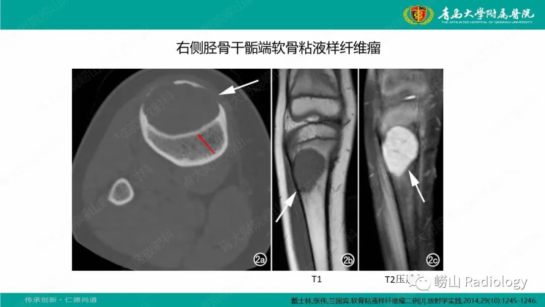 【病例】肱骨干骺端软骨母细胞瘤1例CT及MR-31