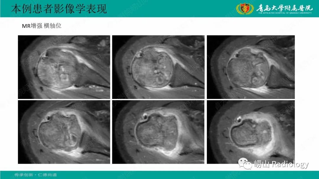 【病例】肱骨干骺端软骨母细胞瘤1例CT及MR-12