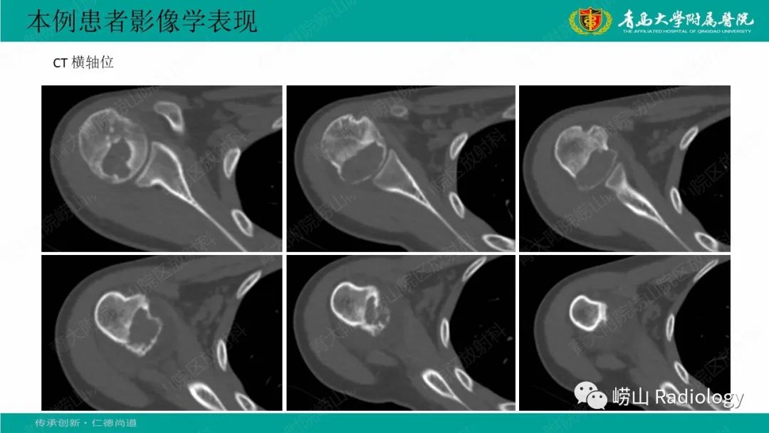 【病例】肱骨干骺端软骨母细胞瘤1例CT及MR-4