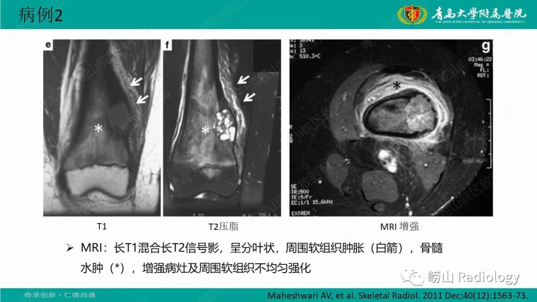 【病例】肱骨干骺端软骨母细胞瘤1例CT及MR-25