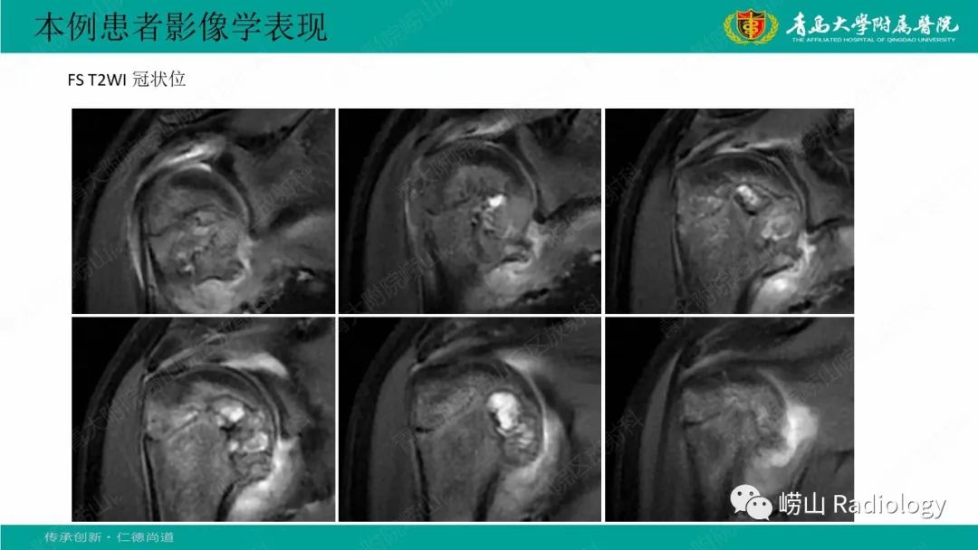 【病例】肱骨干骺端软骨母细胞瘤1例CT及MR-11