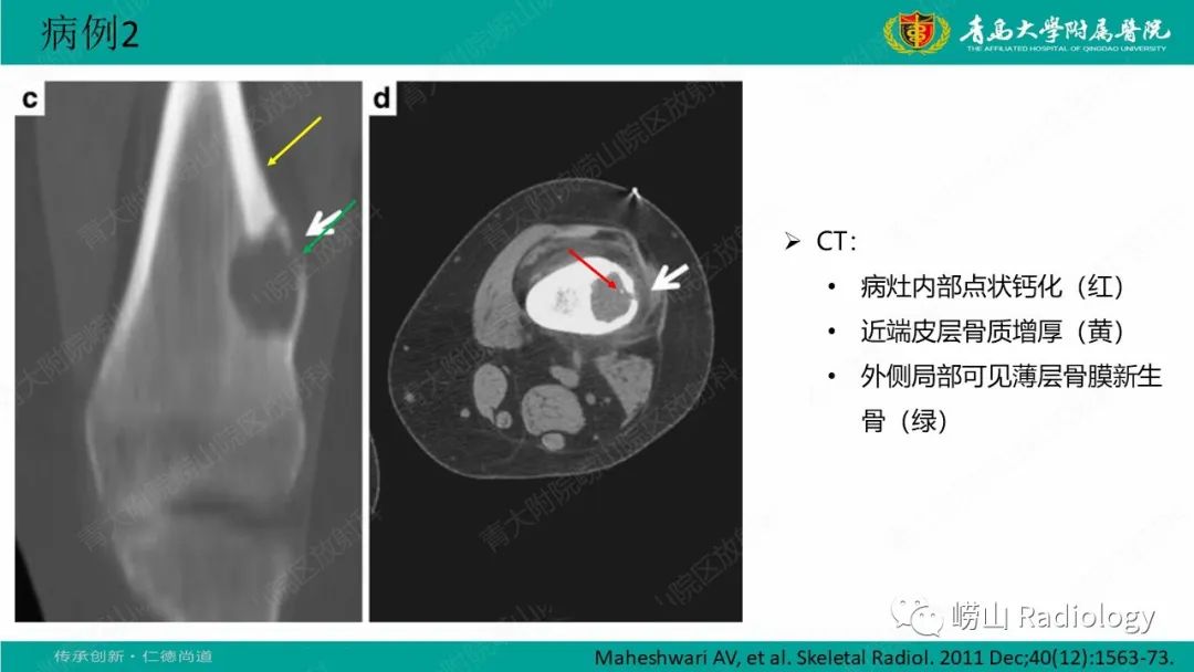 【病例】肱骨干骺端软骨母细胞瘤1例CT及MR-24