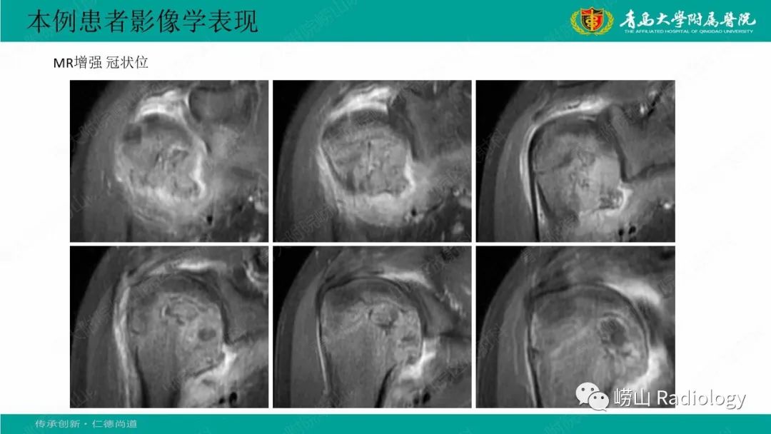 【病例】肱骨干骺端软骨母细胞瘤1例CT及MR-14
