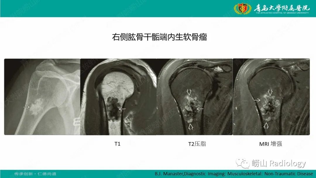 【病例】肱骨干骺端软骨母细胞瘤1例CT及MR-33