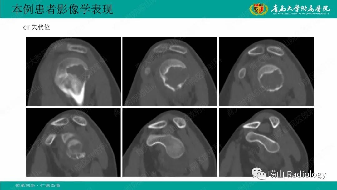 【病例】肱骨干骺端软骨母细胞瘤1例CT及MR-6