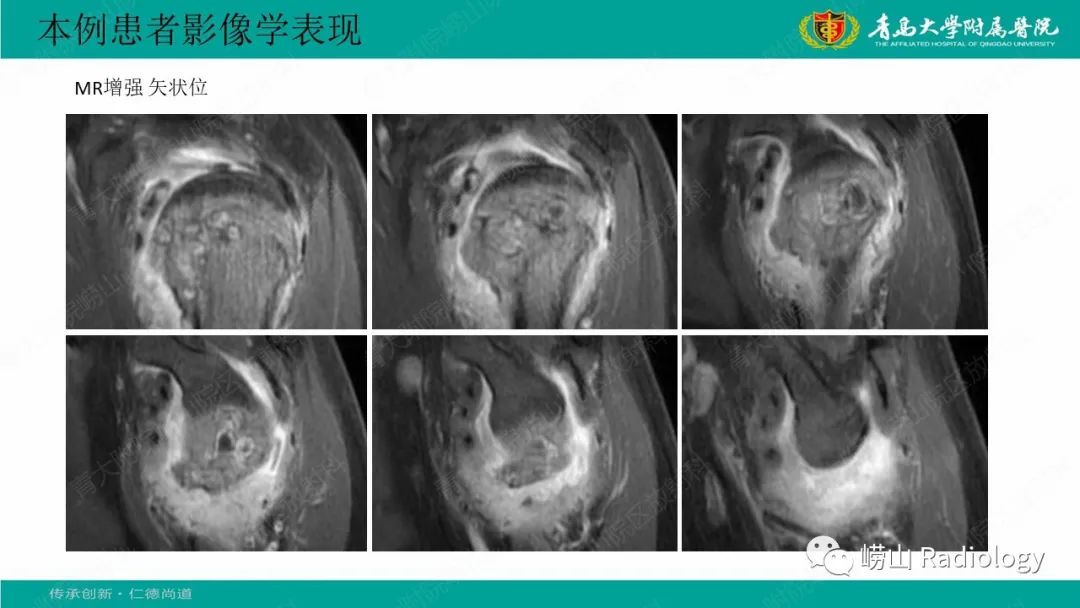 【病例】肱骨干骺端软骨母细胞瘤1例CT及MR-13