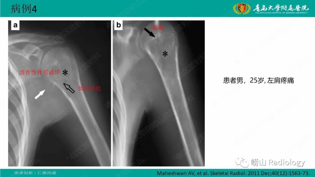 【病例】肱骨干骺端软骨母细胞瘤1例CT及MR-27