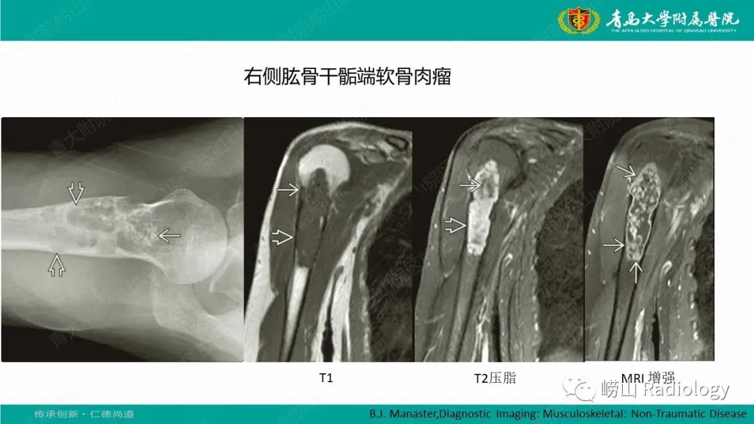 【病例】肱骨干骺端软骨母细胞瘤1例CT及MR-35