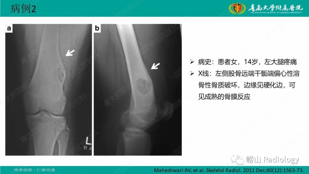 【病例】肱骨干骺端软骨母细胞瘤1例CT及MR-23