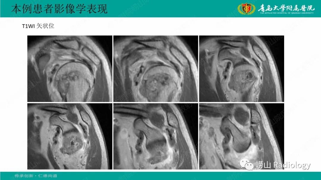 【病例】肱骨干骺端软骨母细胞瘤1例CT及MR-8