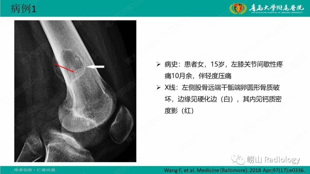 【病例】肱骨干骺端软骨母细胞瘤1例CT及MR-20