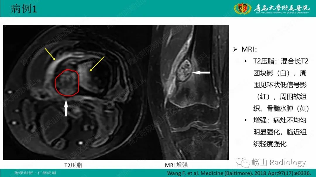 【病例】肱骨干骺端软骨母细胞瘤1例CT及MR-22