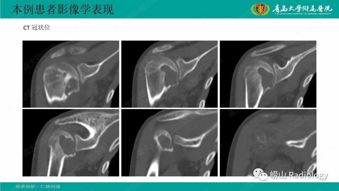 【病例】肱骨干骺端软骨母细胞瘤1例CT及MR-5