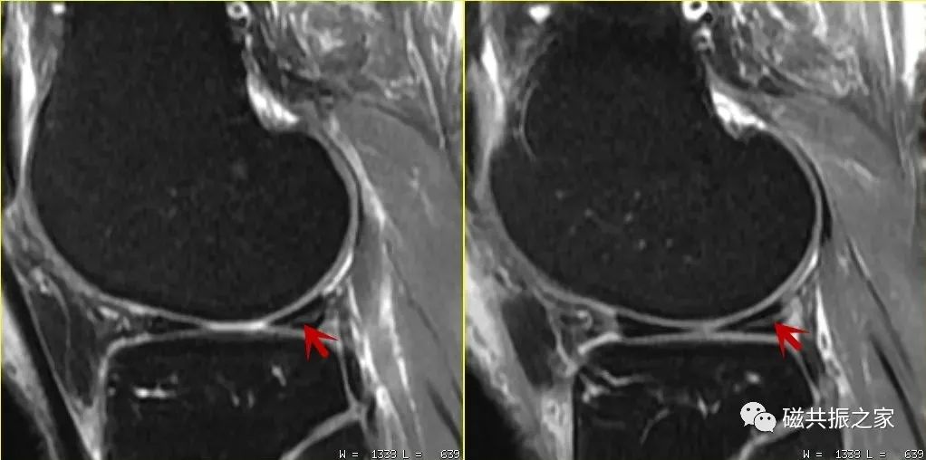 如何做好四肢关节的MRI扫描-8