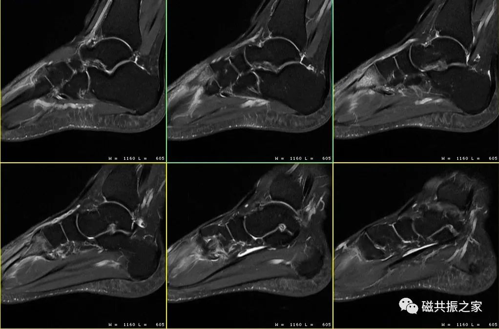 如何做好四肢关节的MRI扫描-2