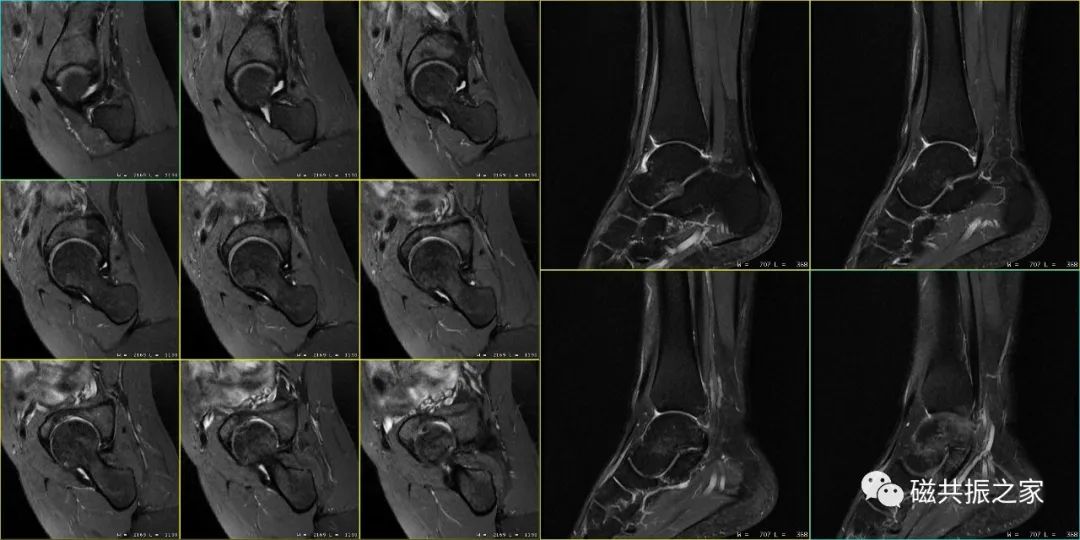 如何做好四肢关节的MRI扫描-10