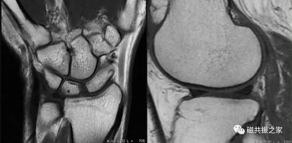 如何做好四肢关节的MRI扫描-5