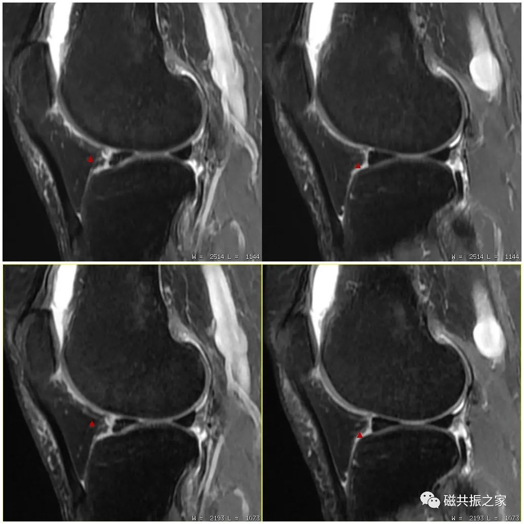 如何做好四肢关节的MRI扫描-9