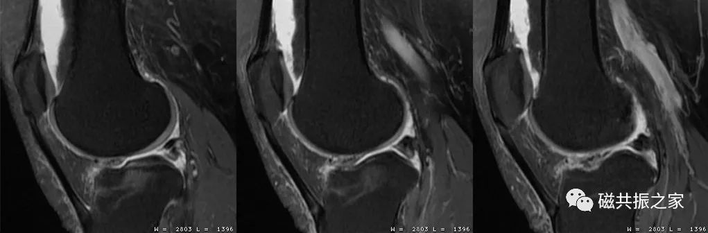 如何做好四肢关节的MRI扫描-6