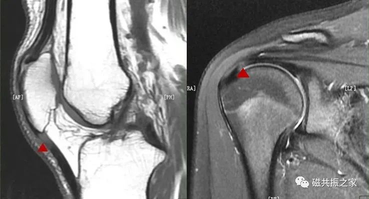 如何做好四肢关节的MRI扫描-13
