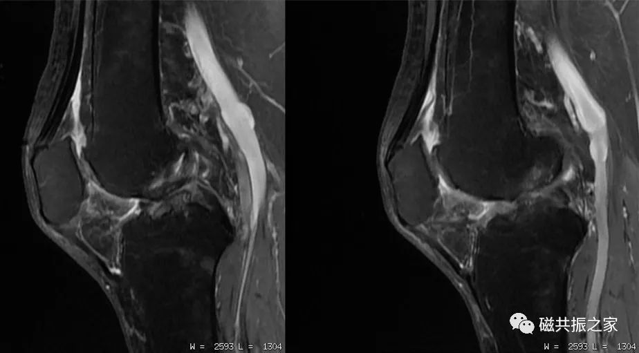 如何做好四肢关节的MRI扫描-4
