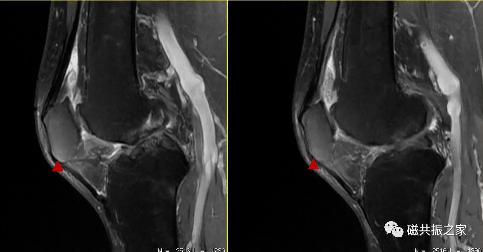 如何做好四肢关节的MRI扫描-3