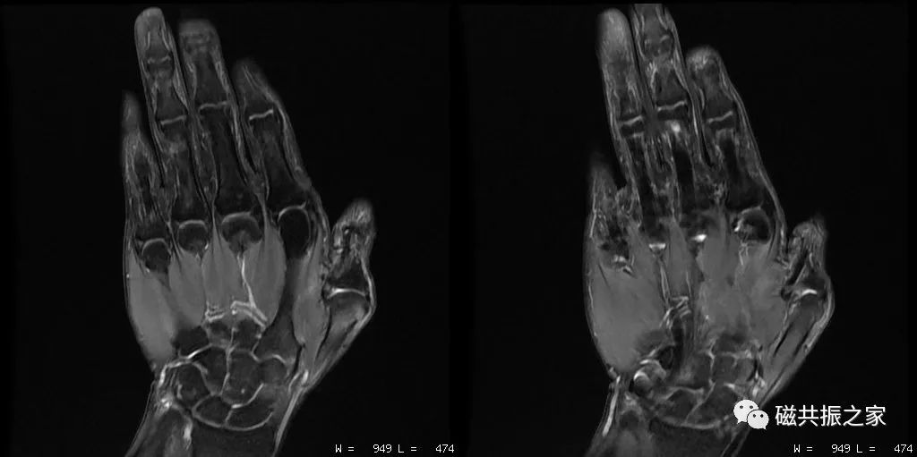 如何做好四肢关节的MRI扫描-11