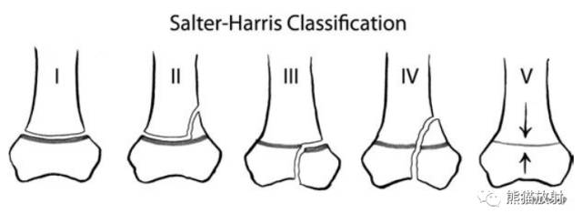 骨骺损伤的分型及影像表现-6