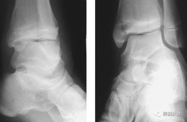 骨骺损伤的分型及影像表现-10
