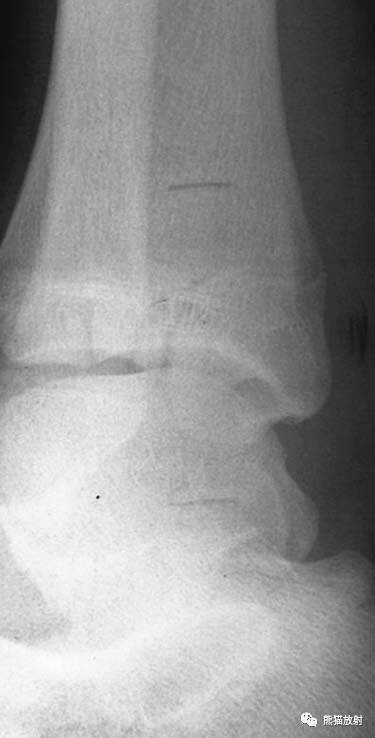 骨骺损伤的分型及影像表现-9