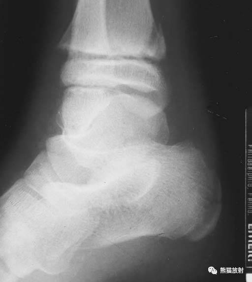 骨骺损伤的分型及影像表现-8