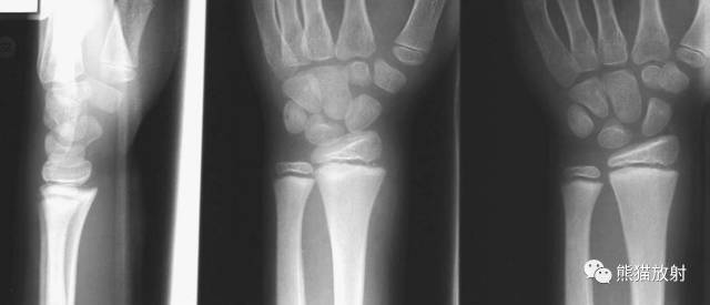 骨骺损伤的分型及影像表现-7