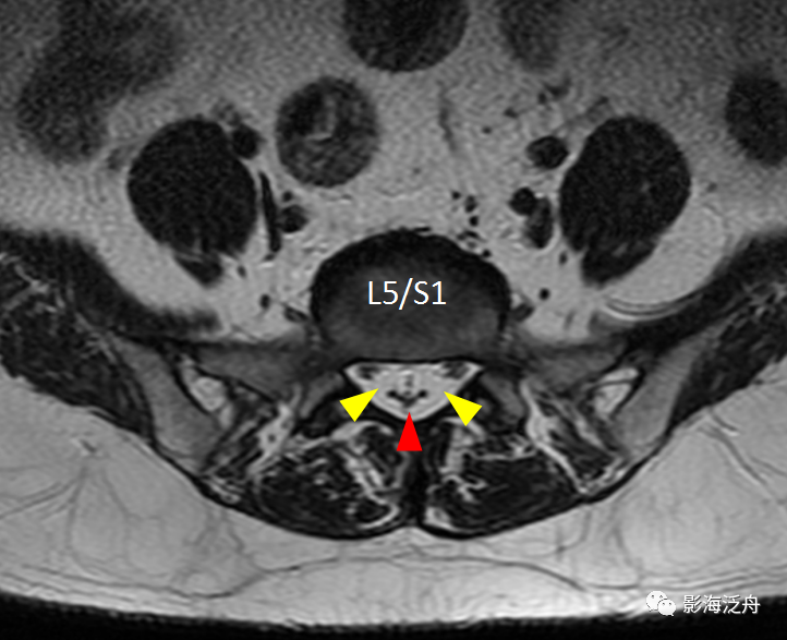 椎管内硬膜外脂肪增多症-12