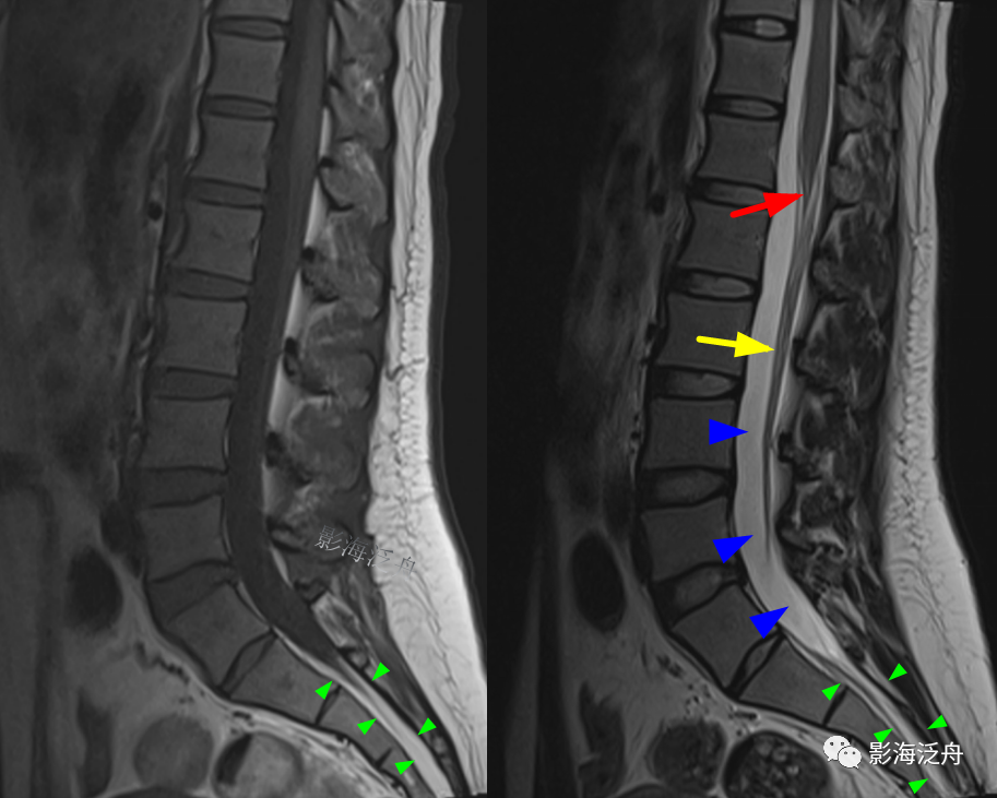 椎管内硬膜外脂肪增多症-9