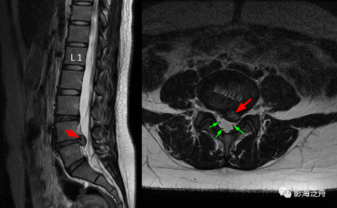 椎管内硬膜外脂肪增多症-13