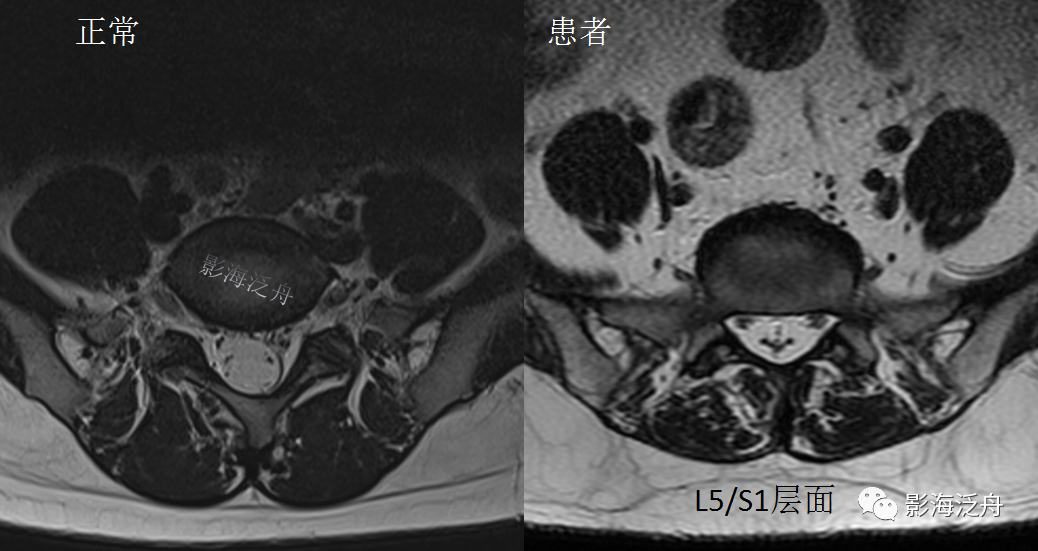 椎管内硬膜外脂肪增多症-16