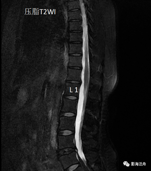 椎管内硬膜外脂肪增多症-1