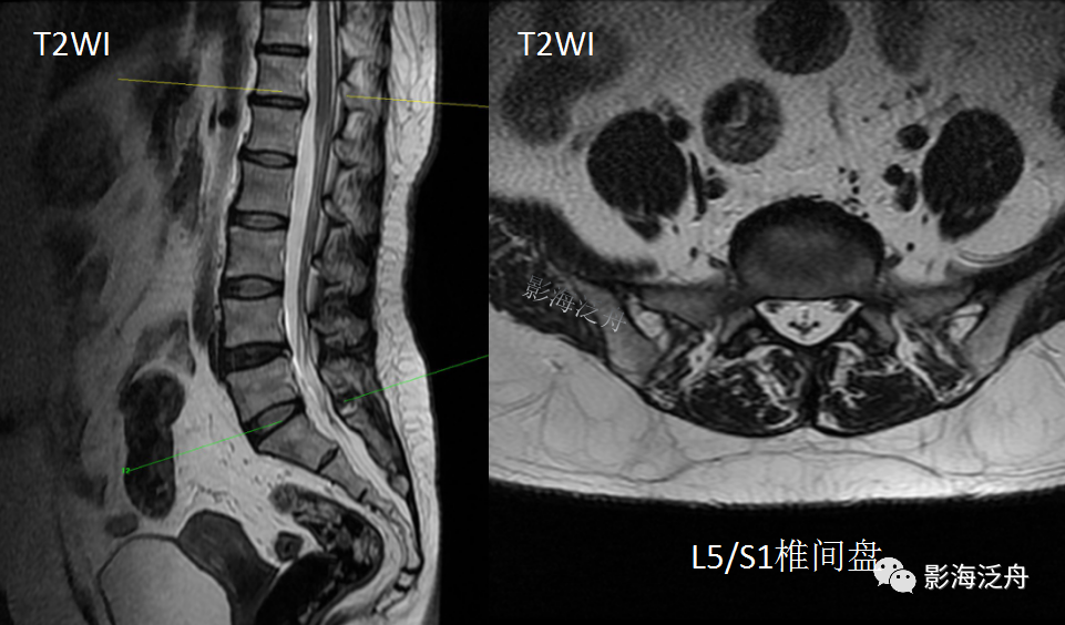 椎管内硬膜外脂肪增多症-5