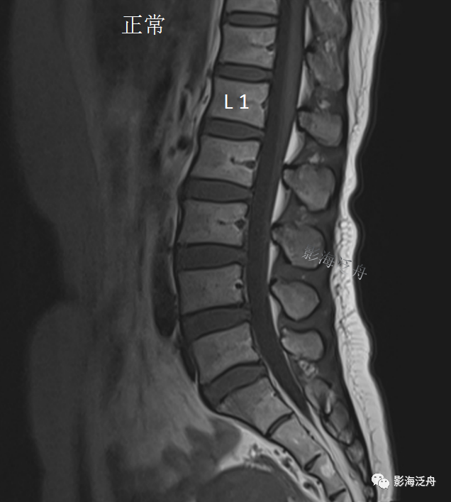 椎管内硬膜外脂肪增多症-7