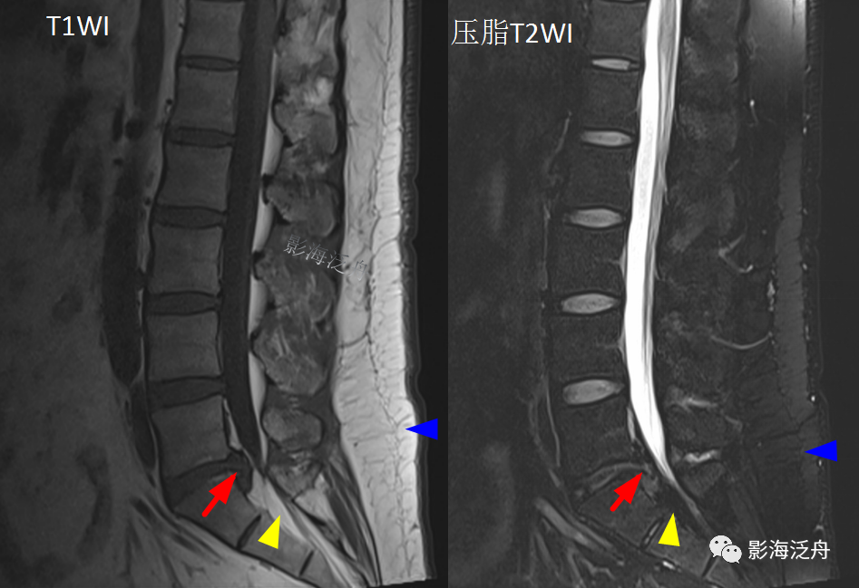 椎管内硬膜外脂肪增多症-14