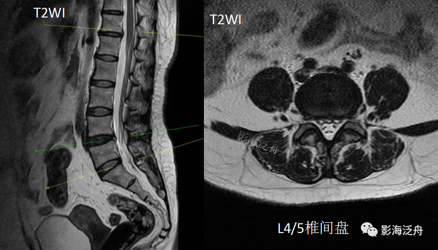 椎管内硬膜外脂肪增多症-2