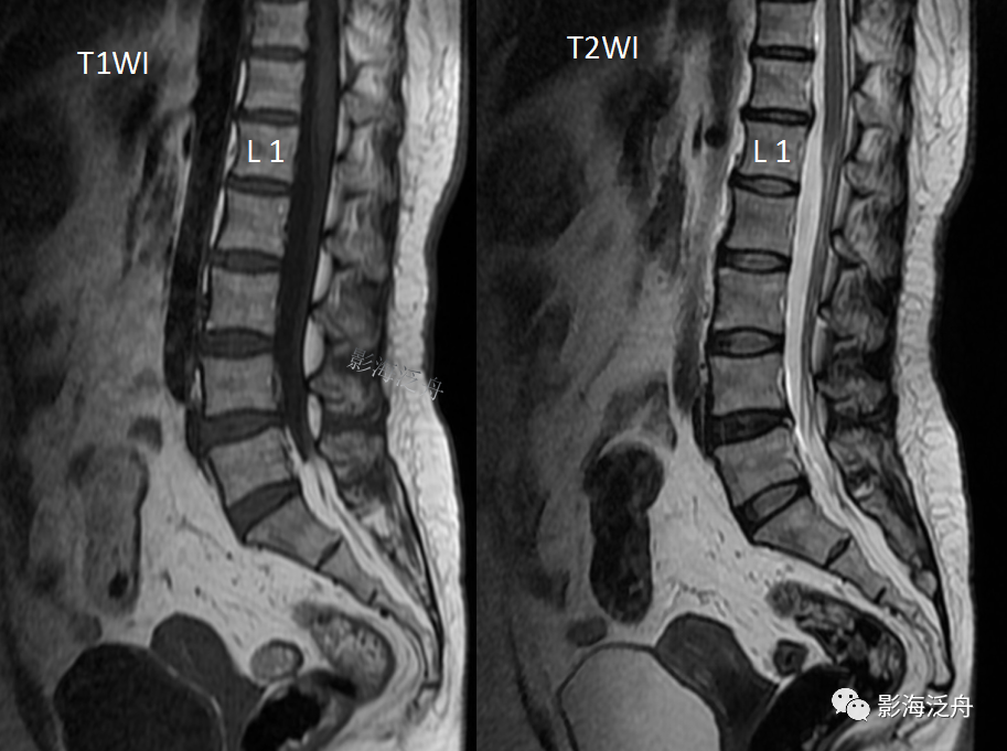 椎管内硬膜外脂肪增多症-3