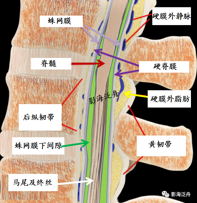 椎管内硬膜外脂肪增多症-10