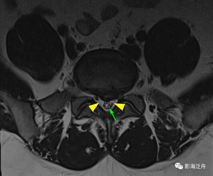 椎管内硬膜外脂肪增多症-15