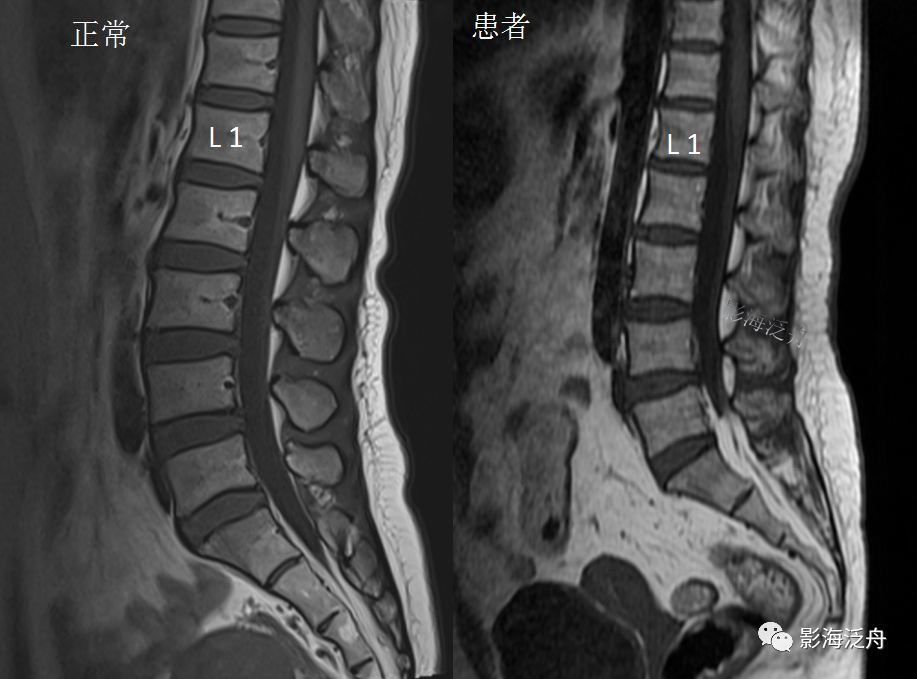 椎管内硬膜外脂肪增多症-8