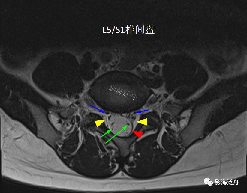 椎管内硬膜外脂肪增多症-11