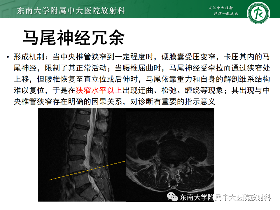 【PPT】椎管内硬膜外脂肪增多症-12